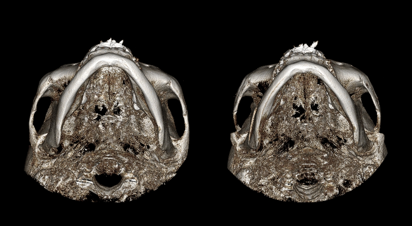 美迪莹颧骨整形案例CT