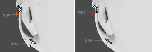 韩国RUBY医院快速颧骨缩小手术细节示意图