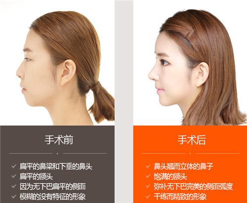 韩国K医院鼻整形vs歌柔飞定制鼻整形哪个效果好？