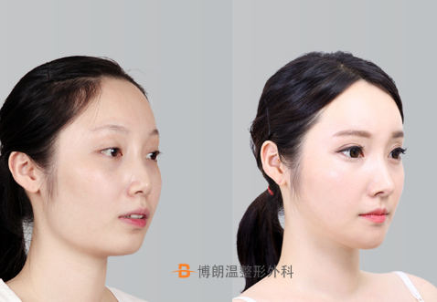 韩国ID整形外科隆鼻前后对比照片