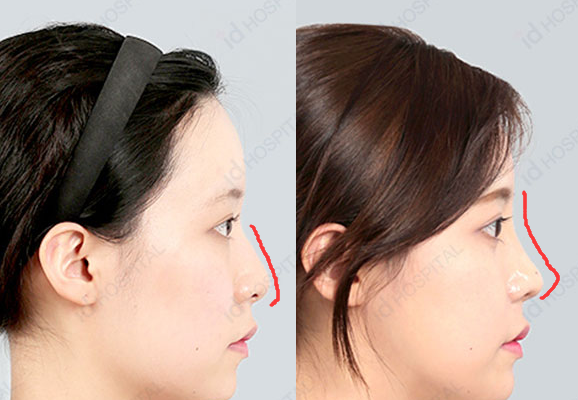韩国ID整形外科隆鼻案例对比图