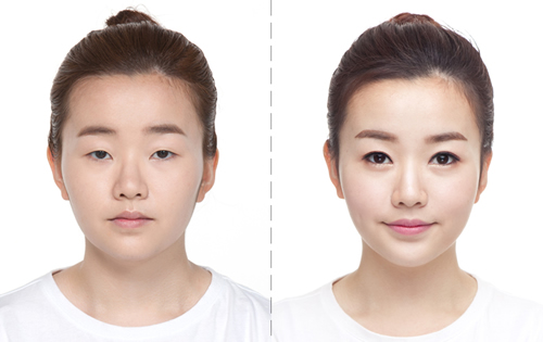 韩国希克丽医院双眼皮手术案例对比