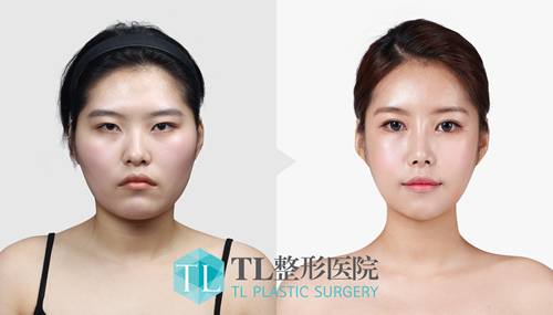 韩国TL整形外科轮廓手术案例对比