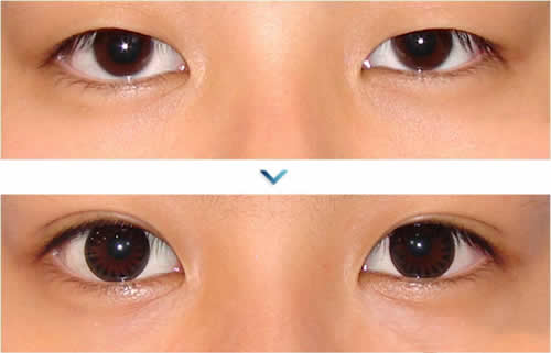 韩国一见整形外科双眼皮手术案例对比