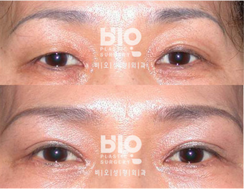 韩国BIO整形外科双眼皮案例