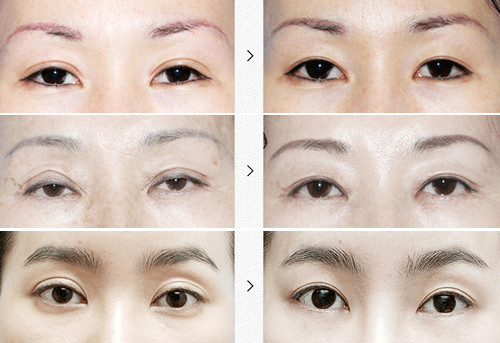 韩国原辰整形外科双眼皮修复案例