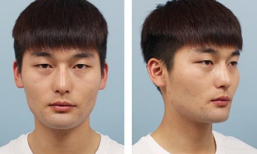 韩国爱我面部轮廓术前案例