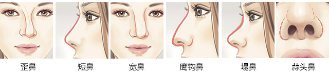鼻部问题以及各种鼻部形态
