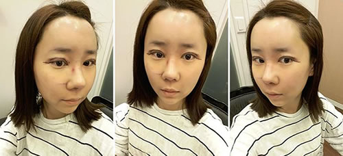 韩国加美眼鼻整形+面部填充案例