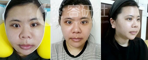 韩国JAYJUN整形医院金起完双鄂手术，V脸重塑，浑然天成