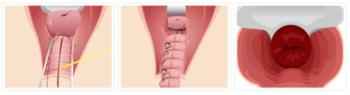 后方膣圆盖术手术过程示意图