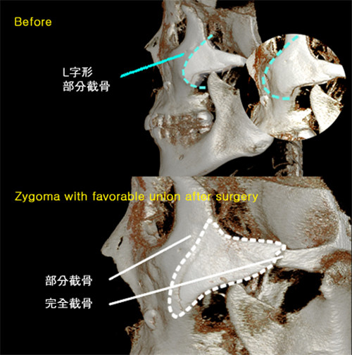 韩国绮林整形外科颧骨整形示意图