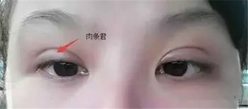 双眼皮修复方法