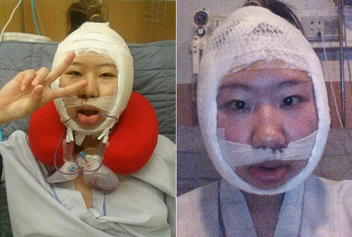 在韩国梦想整形外科做了双鄂手术
