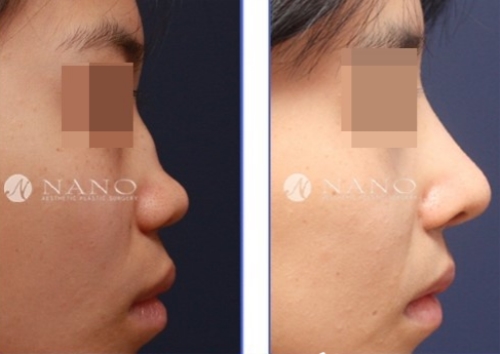 韩国nano畸形鼻矫正隆鼻手术