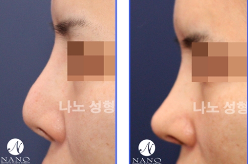 韩国nano圆头鼻隆鼻手术 真人案例