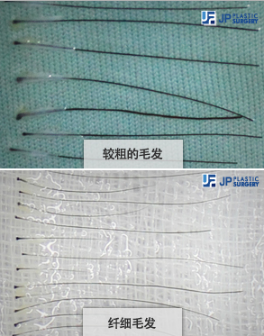 韩国JP医院做植发手术优势展示