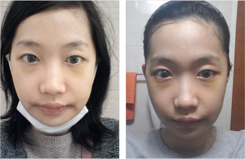 韩国巴诺巴奇双鄂+颧骨缩小手术三个月后变童颜美少女