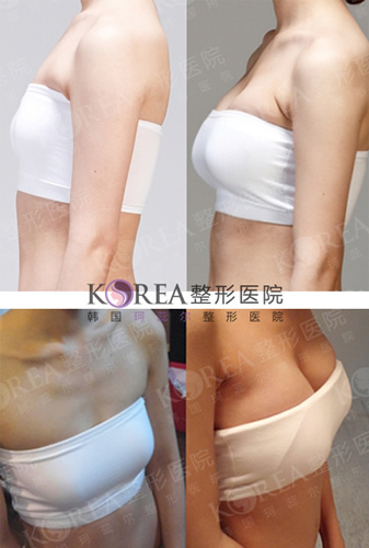 韩国KOREA整形外科隆胸日记对比