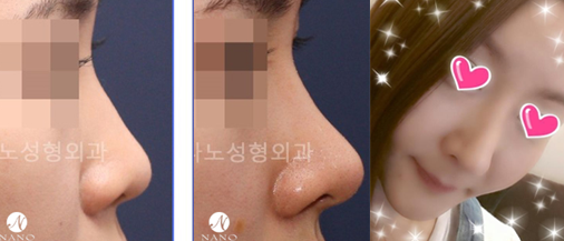 韩国nano整形外科隆鼻前后对比图