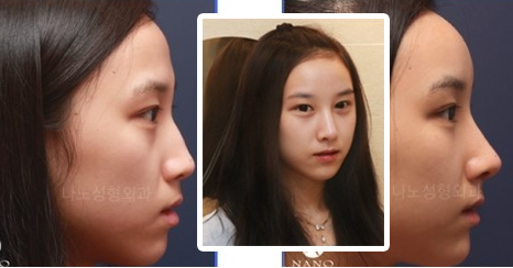 韩国nano整形外科鼻子整形前后案例