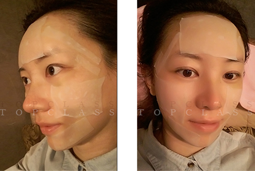 韩国TOPCLASS整形外科假体隆鼻术后护理