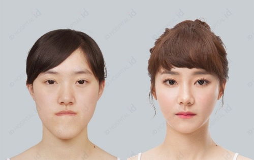 韩国ID医院面部轮廓真人案例效果