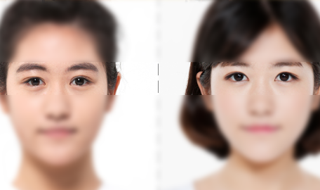 韩国希克丽双眼皮手术案例照片