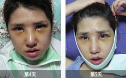 韩国博朗温面部轮廓+眼鼻整形术后4~5天面部恢复图