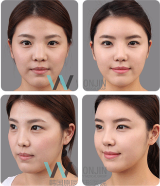 韩国原辰整形外科隆鼻前后对比案例