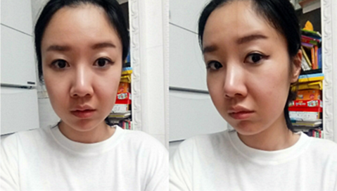 韩国ID微创拉皮术前照片
