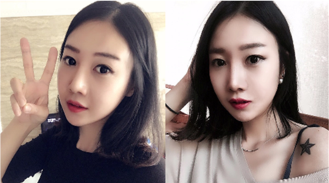 韩国ID微创拉皮术后一个月恢复图