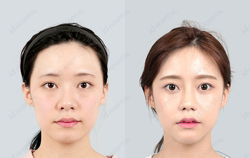 韩国ID整形外科颧骨缩小前后对比图