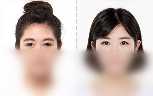 韩国希克丽医院双眼皮修复案例对比