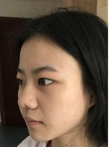 韩国碧夏自体软骨隆鼻案例术前图