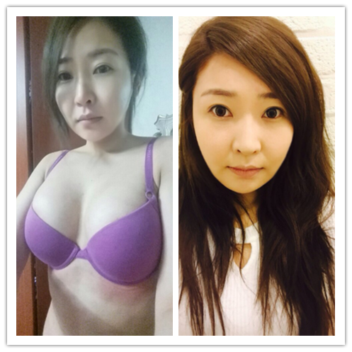 韩国体引脂面部吸脂术后照片