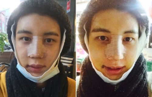 韩国A特整形医院面部轮廓眼鼻综合手术术后恢复第五天
