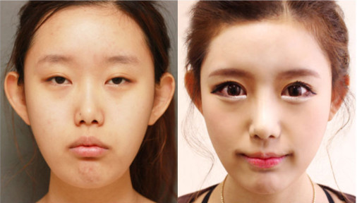 韩国江南DNA整形医院双眼皮对比案例