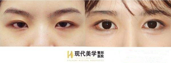 韩国现代美学整形外科双眼皮对比案例