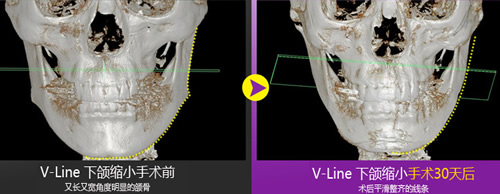 韩国A特整形外科轮廓截骨展示