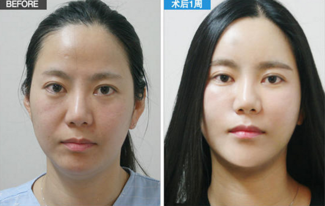韩国维摩整形外科脂肪填充对比案例