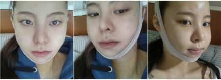 韩国JAYJUN医院下颌角整形术后恢复一周