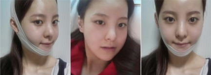 韩国JAYJUN医院下颌角整形术后恢复两周