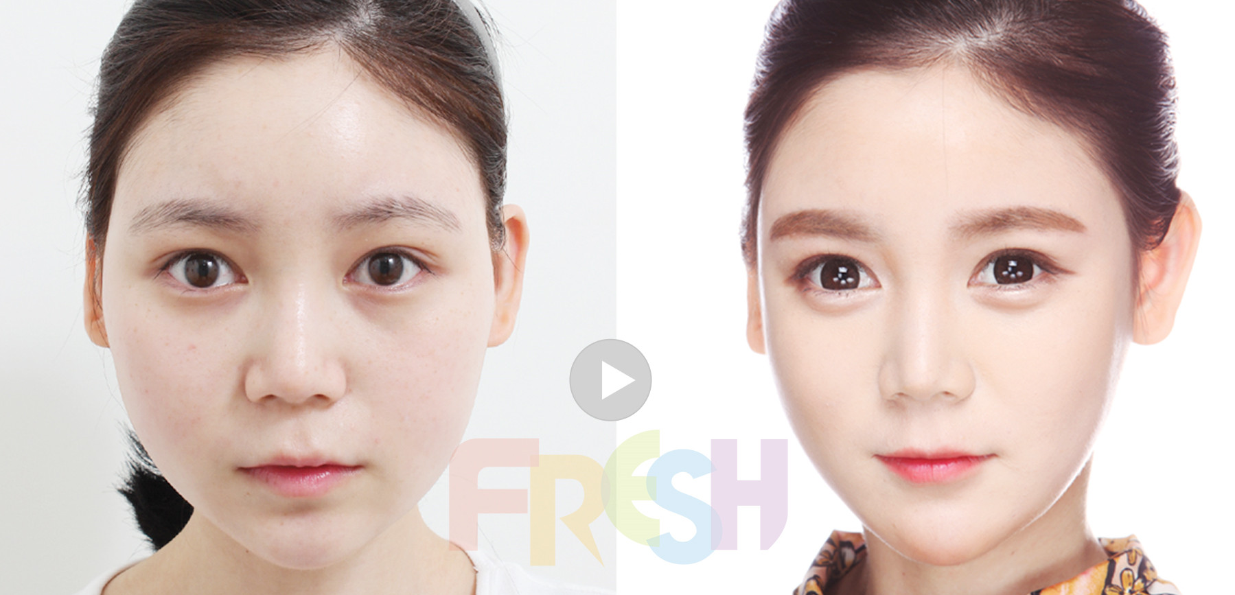 韩国芙莱思整形外科VS友珍医院面部吸脂哪家瘦脸效果更好？