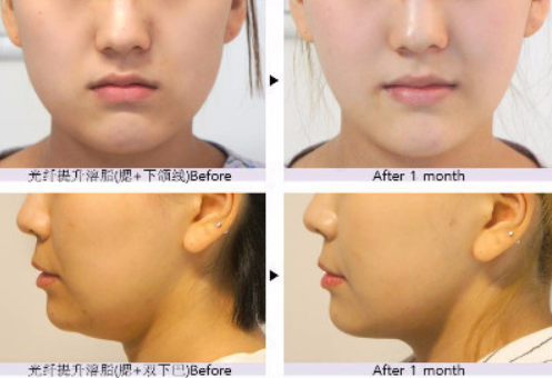 韩国芙莱思整形外科VS友珍医院面部吸脂哪家瘦脸效果更好？