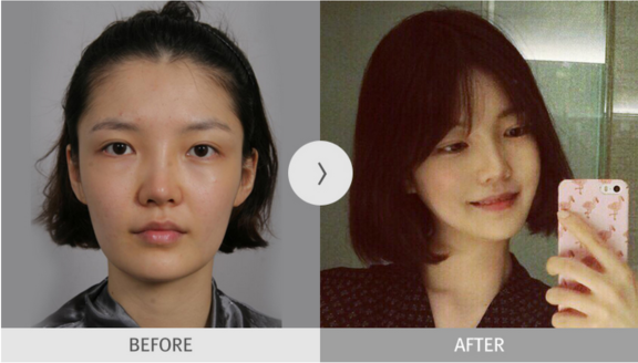 韩国麦恩双眼皮手术对比案例