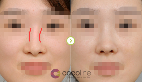 cocoline做鼻子整形案例