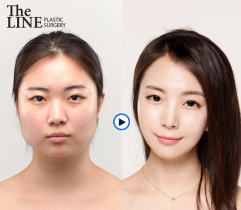 韩国德莱茵整形外科下颌角整形对比案例