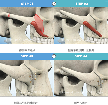 珠儿丽医院做3D颧骨缩小技术+案例解析！