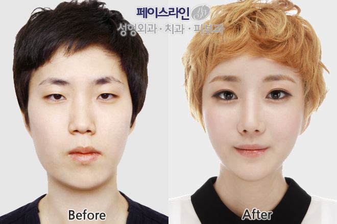  韩国faceline整形外科轮廓整形前后对比